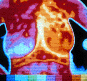 Image: Thermography produces an infrared image that shows the patterns of heat and blood flow on or near the surface of the body (Photo courtesy of the FDA).